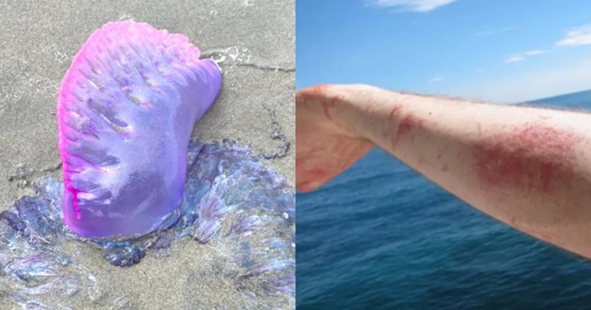 Aumenta a 8 el número de incidentes por picaduras de medusas en Miramar durante la Semana Santa