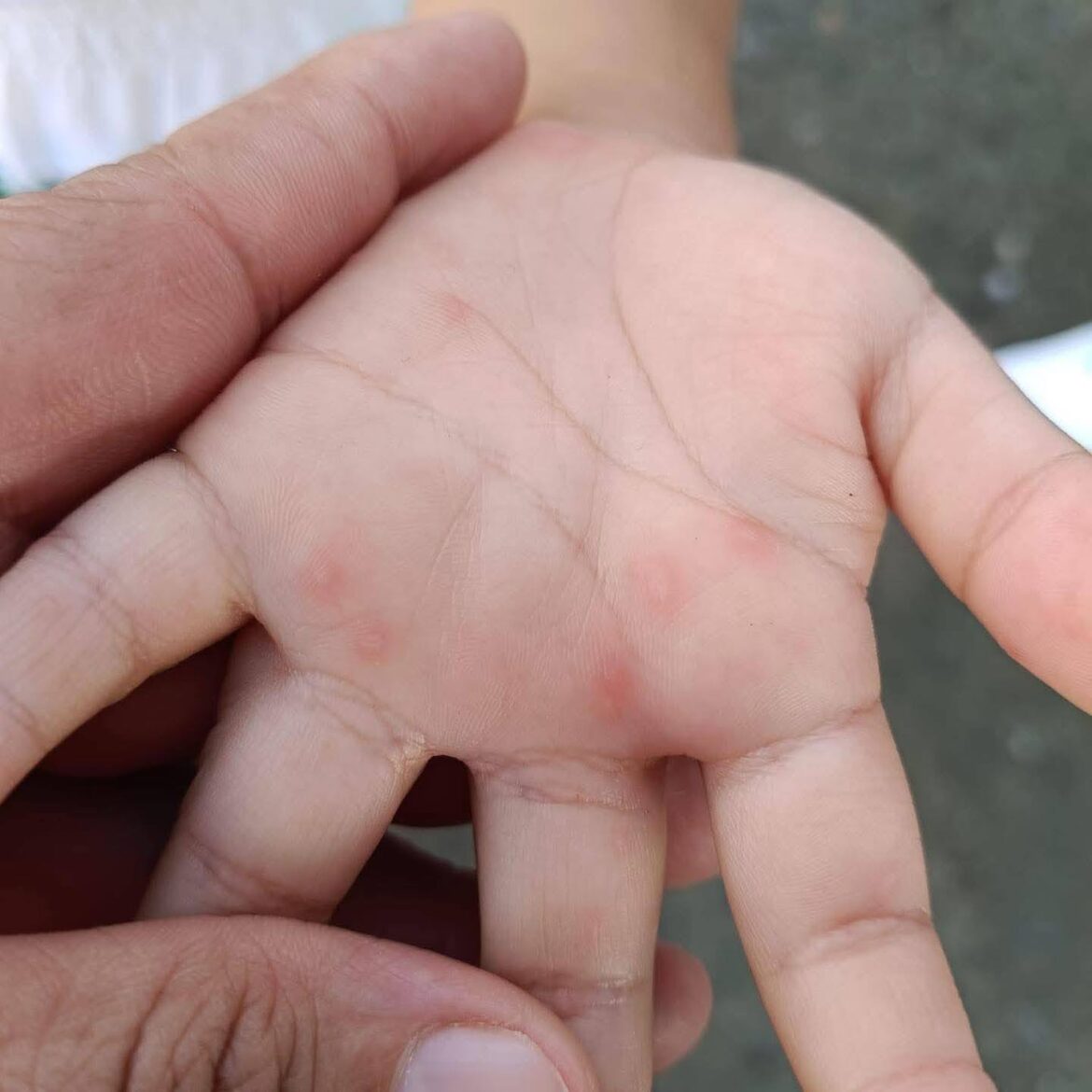 Detectan 128 casos de virus manos-pies-boca en Tamaulipas