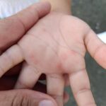 Detectan 128 casos de virus manos-pies-boca en Tamaulipas