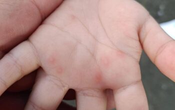 Detectan 128 casos de virus manos-pies-boca en Tamaulipas