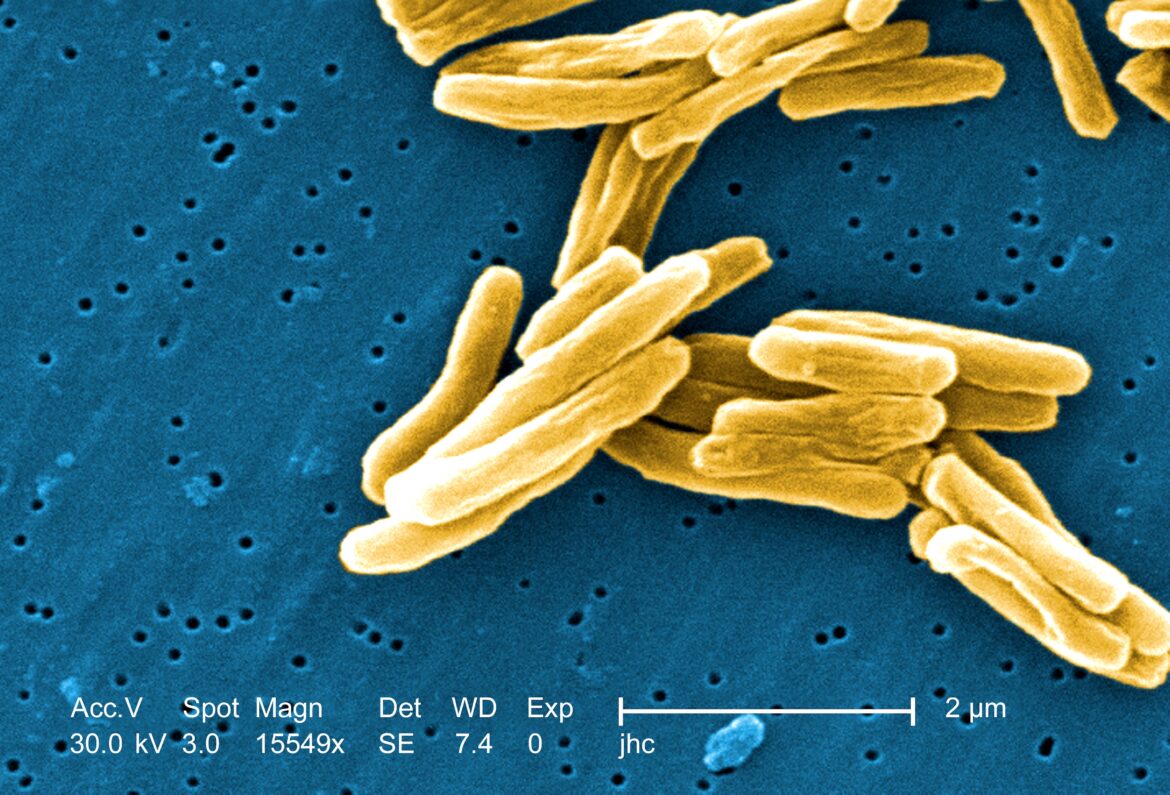 Activan alerta epidemiológica por ocho casos de tuberculosis en Tampico