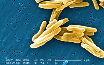 Activan alerta por 8 casos de tuberculosis en Tampico